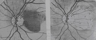 Choroidal melanoma