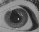 Iridotomy 